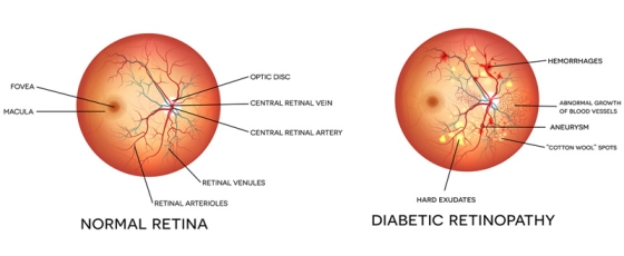 https://www.eye7.in/wp-content/uploads/illustration-showing-diabetic-retinopathy.jpg