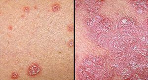 Psoriasis- skin problems