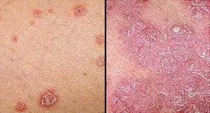 Psoriasis- skin problems