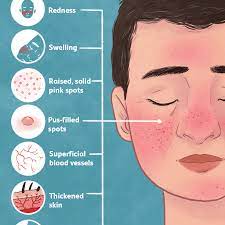 Rosacea- skin problem