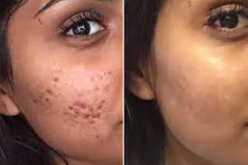 Causes of acne