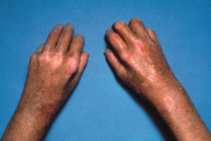 Causes of scleroderma- skin problems