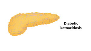 DKA (Diabetes Ketoacidosis)