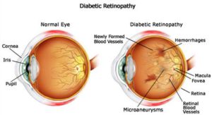 Retinopathy