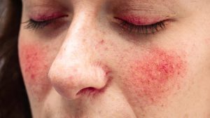 Rosacea- skin problems