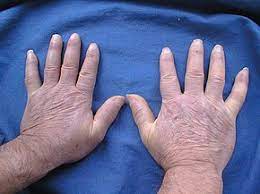 scleroderma- skin problems