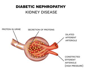 Diabetic Neuropathy