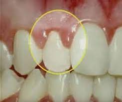 infection in gums