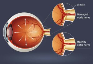 ocular hypertension v/s glaucoma