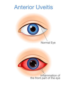 symptoms of ocular hypertension