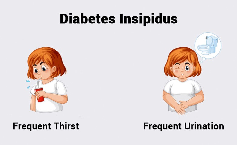 Diabetes Insipidus Types Causes Symptoms And Treatment 7242