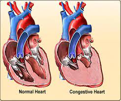 Congestive heart failure