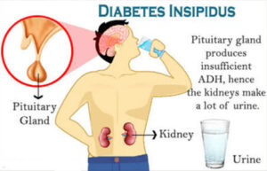 Diabetes Insipidus