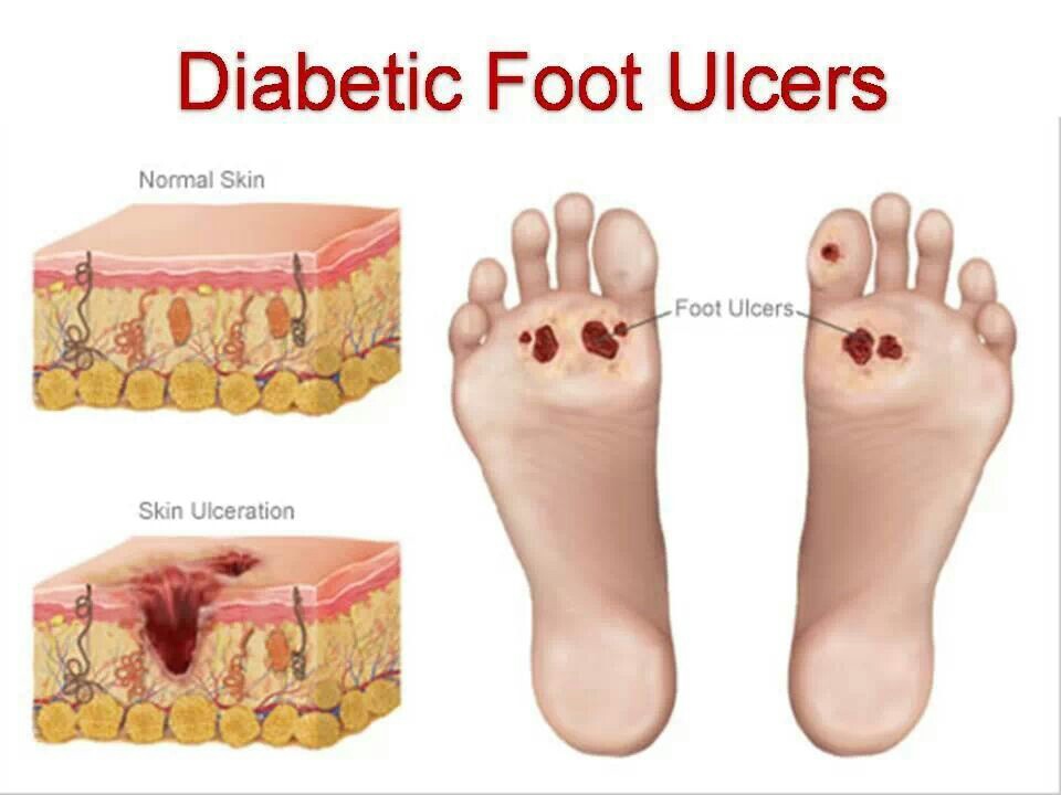 Diabetic Ulcers