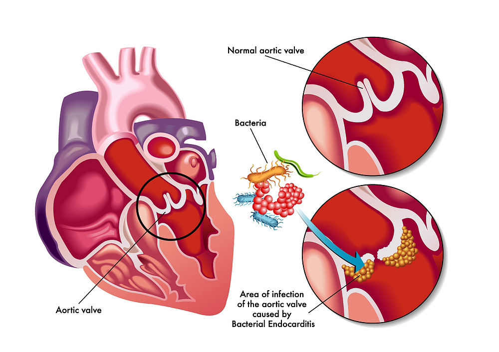 Endocarditis