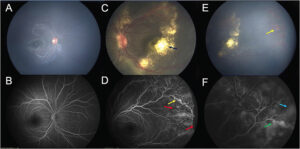 Diabetic Eye problems