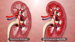 Glomerulonephritis