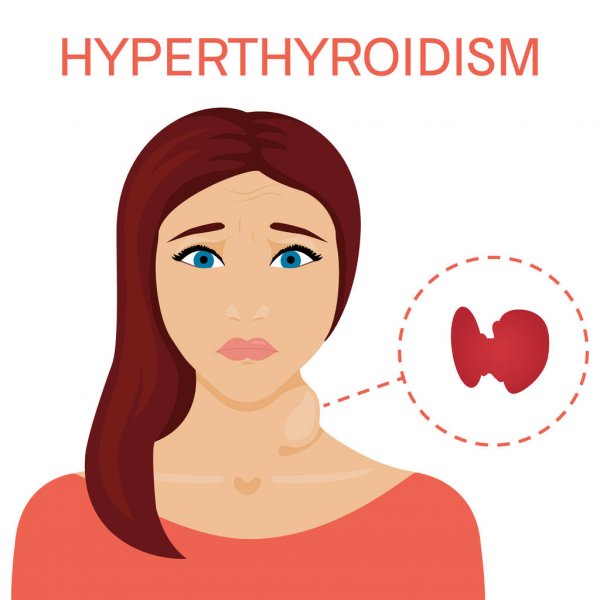 Hyperthyroidism