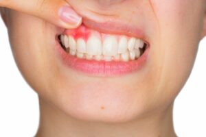 Infections in Gums