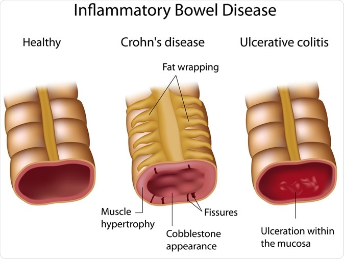 Inflammatory Bowel Disease