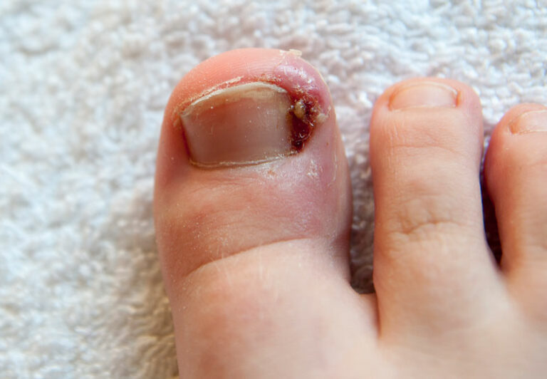 10. Big Toe Nail Color Change and Diabetes - wide 6