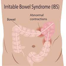 Irritable Bowel Syndrome