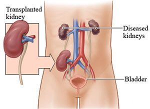 Kidney Transplant