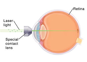 diabetic eye