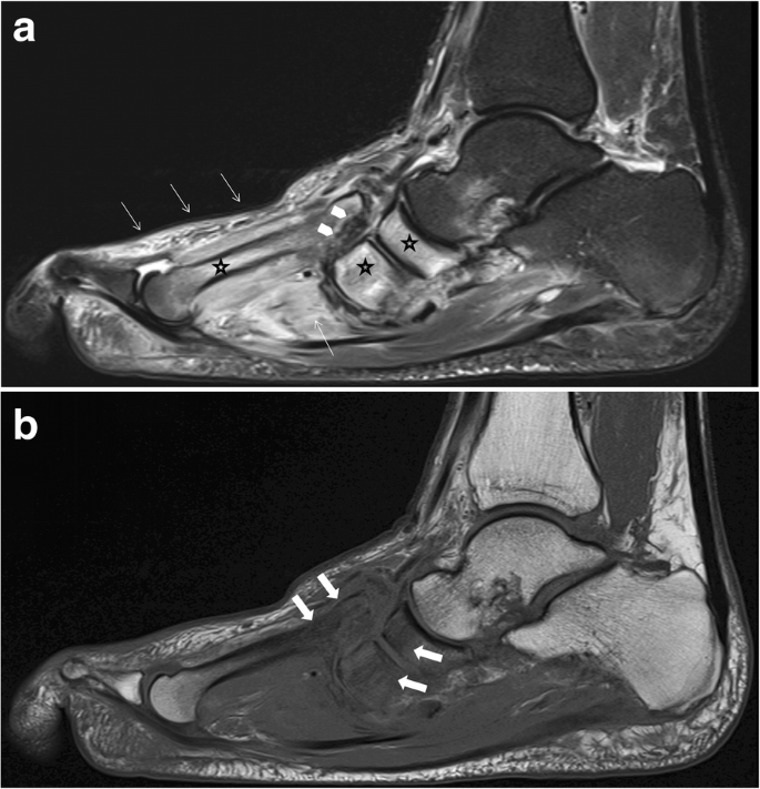 MRI of Charcot foot