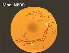 Moderate NPDR