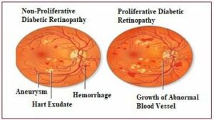 types of diabetic retinopathy