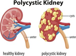 Polycystic Kidney Disease