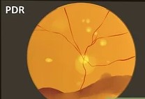 Proliferative Diabetic Retinopathy