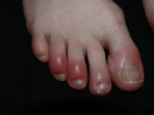 Red Feet (Foot Redness): Symptoms, Causes & Treatment
