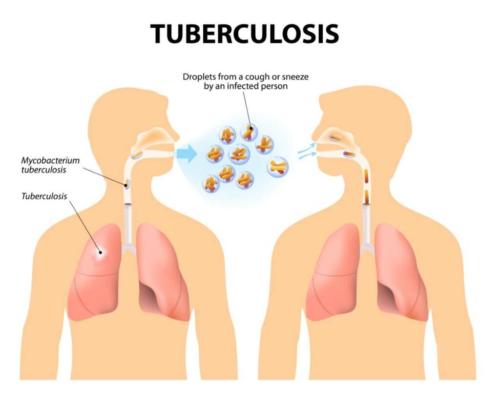 Tuberculosis 