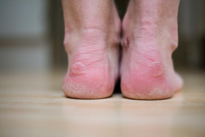 diabetic-foot-symptoms-diagnosis-and-treatment