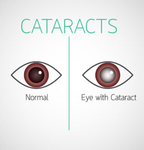 cataract in diabetes