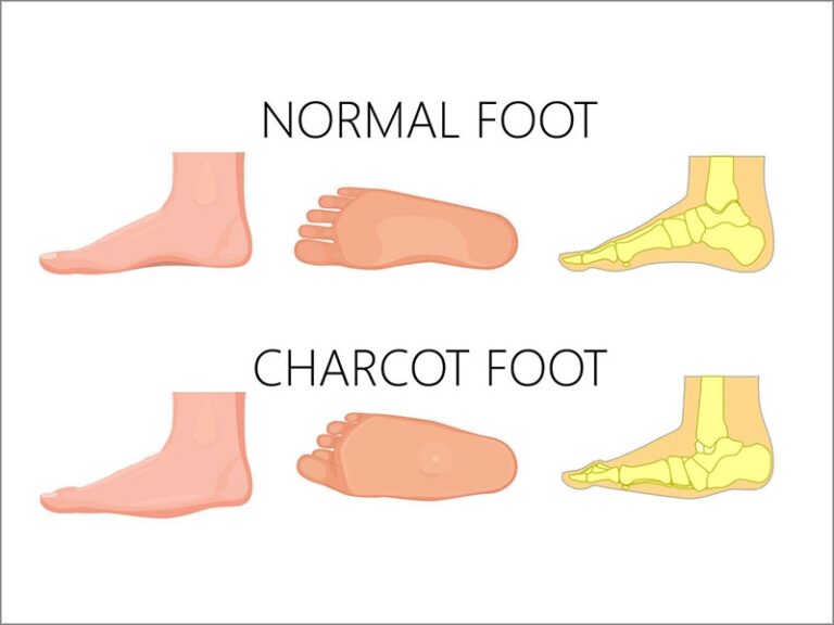 Charcot Foot Symptoms Causes And Treatments Diabetes Care