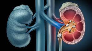 Chronic Kidney Disease