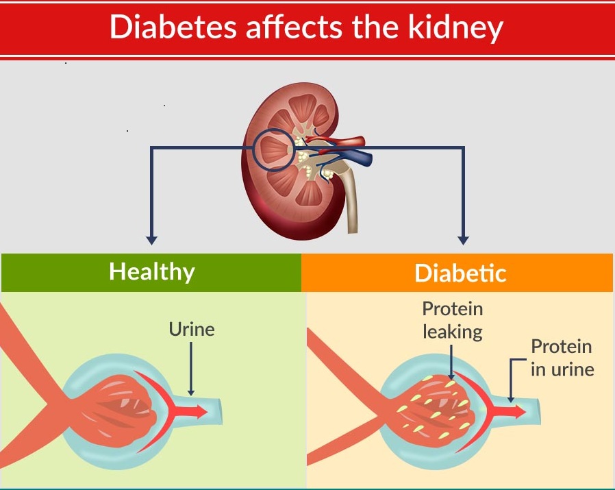 diabetes affect kidney