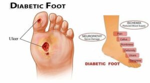 diabetic foot