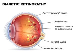 diabetic-retinopathy