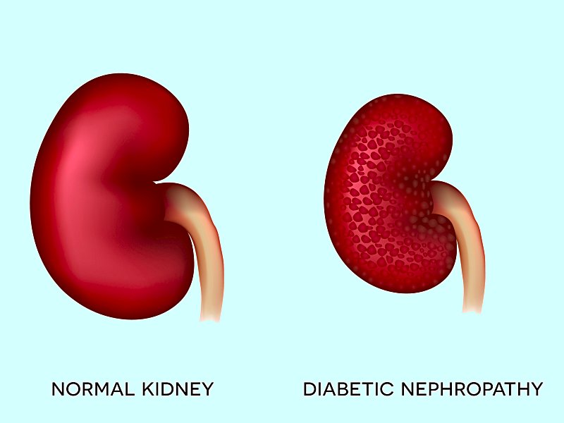 diabetic nephropathy