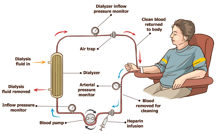 dialysis for kidney disease