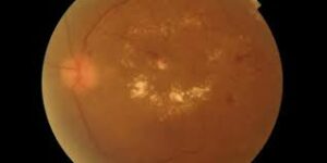 Diabetic Macular Edema