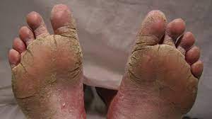 Athlete’s diabetic Foot