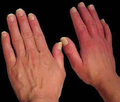 Erythromelalgia