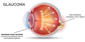 glaucoma