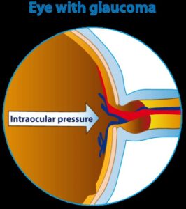 glaucoma-eye