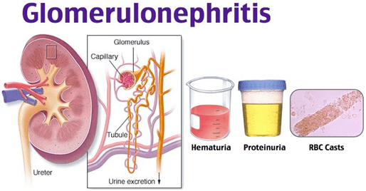 Glomerulonephritis